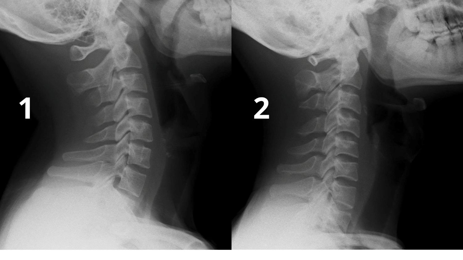 La columna cervical normal (Figura 1) y la perdida de curvas fisiologicas de la columna cervical (Figura 2). Foto: El hospital proporciona