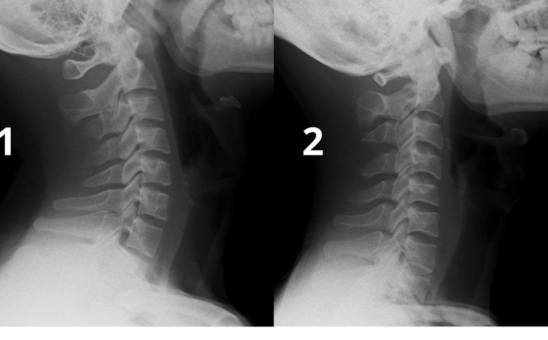 binh thuong cervical spine (photo 1) and loss of cervical spine curves (photo 2). Photo: Provided by the hospital