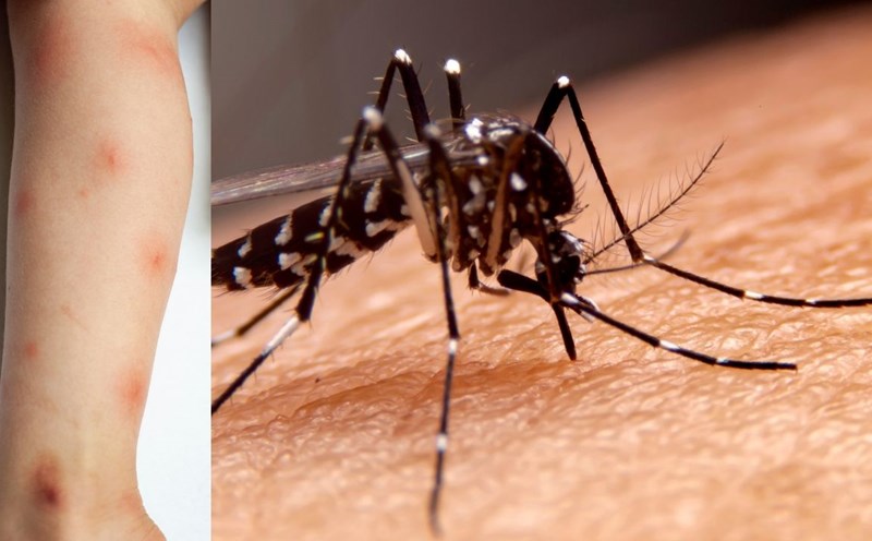 Factors that make you more susceptible to mosquito bites than usual