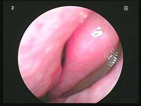 The child was living in the nasal cavity of a man in Ky Hop commune. Photo: Quang Tuan.