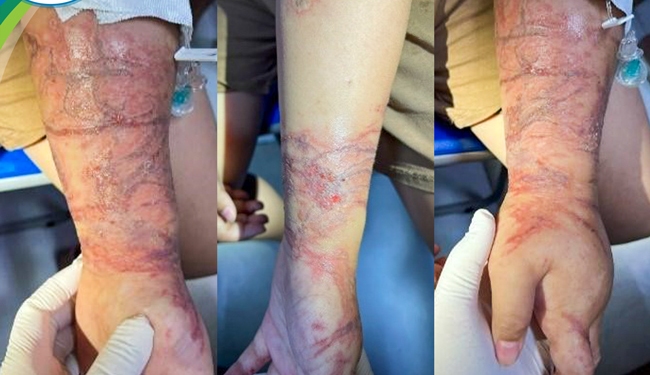 P.L's skin was damaged when she was attacked by sea rhinos. Photo: Provided by the hospital