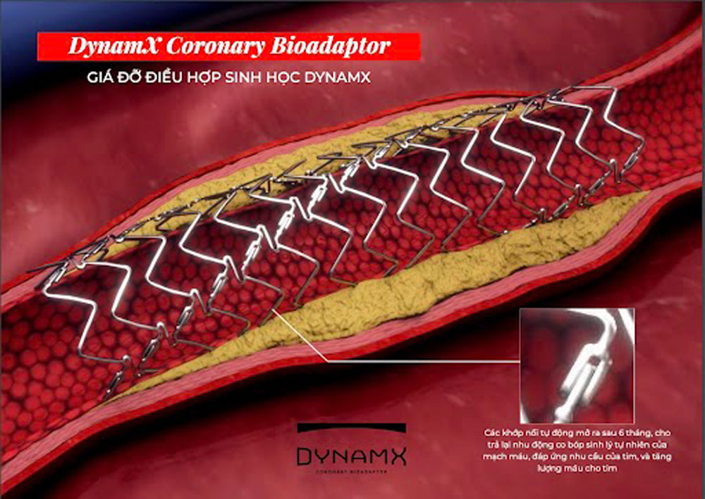 La estructura especial con articulaciones auto -separantes ayuda a la nueva generacion de compatibilidad biologica Dynamx Bioadaptor "liberar" los vasos sanguineos despues de la intervencion cardiovascular. Foto: Enterprise proporcionada