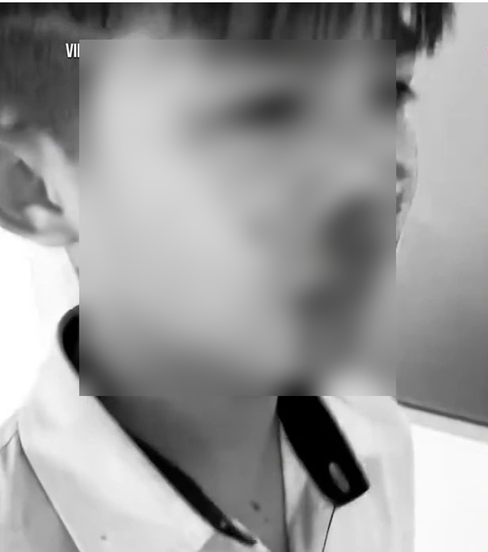 El estudiante de Nguyen Van T fue golpeado en la nariz y la nariz. Foto: NGOC Hai