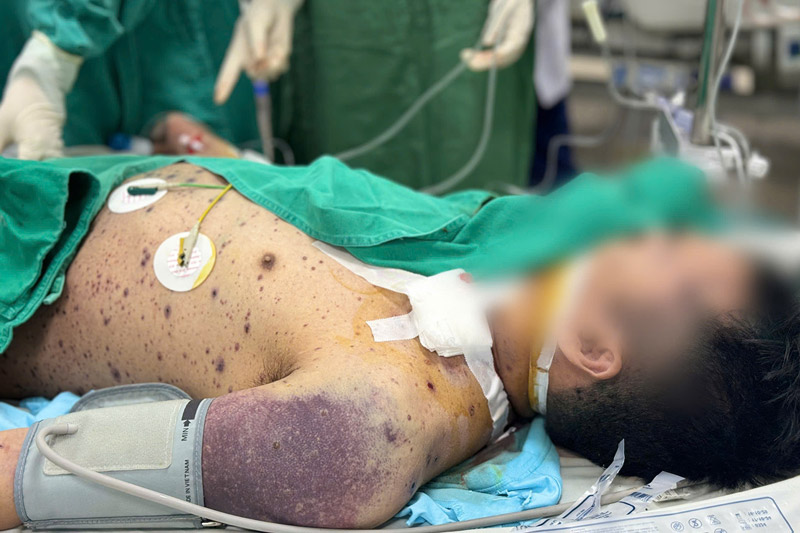 No underlying diseases, 34-year-old patient is still in critical condition due to chickenpox