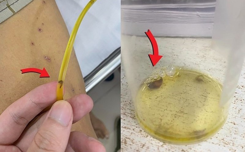 Image of stewed liver leaves from the giallocutaneous duct. Photo: Provided by the hospital