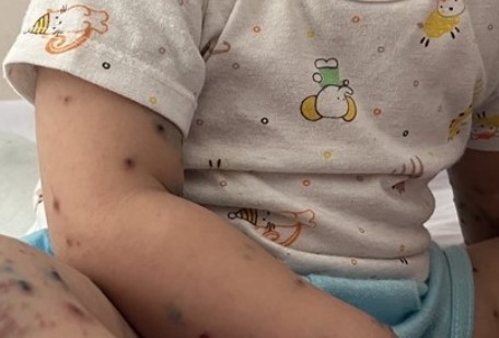 Children with hand, foot and mouth disease. Photo: Nguyen Ly