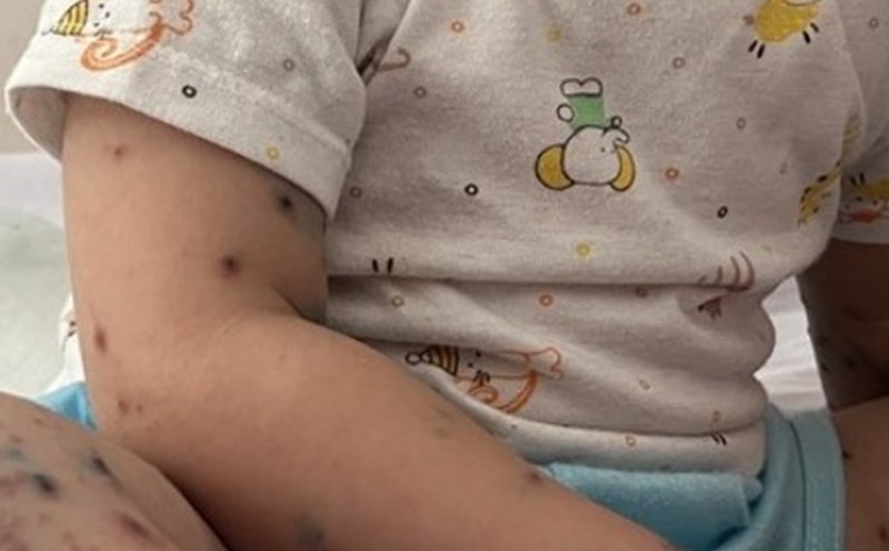 Children with hand, foot and mouth disease. Photo: Nguyen Ly