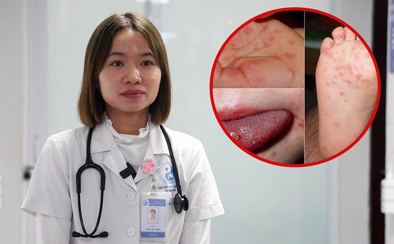 Tips for preventing and caring for children properly when they have hand, foot and mouth disease