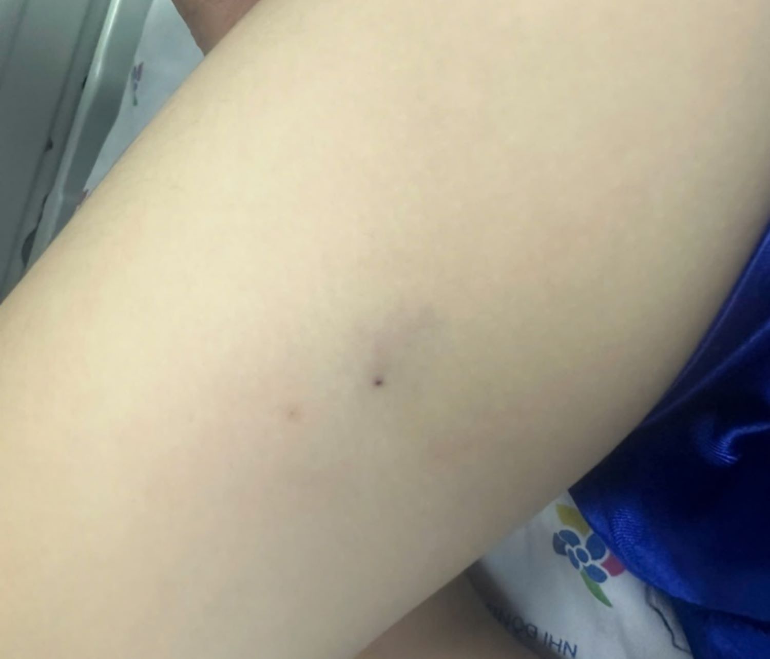 Bees fly bites can cause anaphylactic shock. Photo: Provided by the hospital