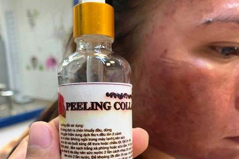 The patient has a happenstance cosmetic allergy and must be treated at the Central Dermatology Hospital. Photo: Provided by the Central Dermatology Hospital