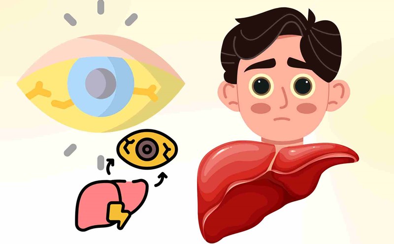 5 signs in the eyes that liver leaves are damaged