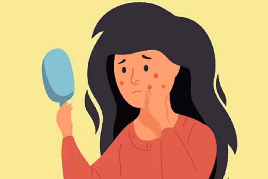 No todas las manchas son iguales y algunas zonas de la cara con manchas son mas propensas a complicaciones por acne. El dibujo: