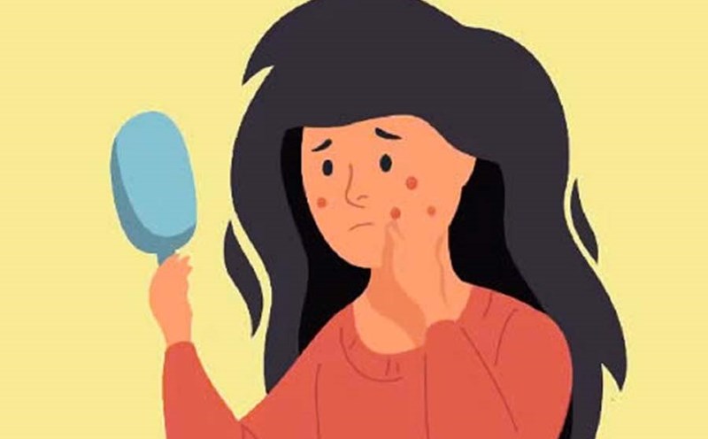 Not all acne points are the same and some places on the face with acne are more susceptible to complications when shaped. Graphics: Bao Ngoc