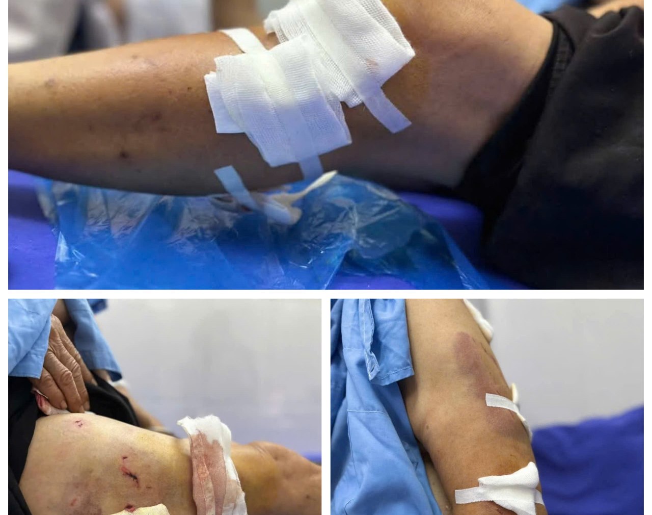 Mrs. R was bitten by a herd of dogs, causing many serious injuries. Photo: Luc Yen District Medical Center.