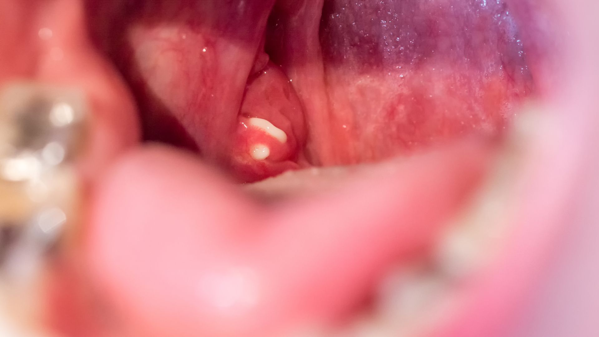 tonsillitis needs to be examined carefully for a suitable treatment diagnosis by the doctor. Photo: Nhu Quynh