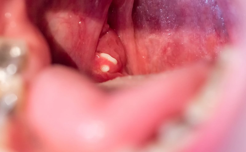 tonsillitis needs to be examined carefully for a suitable treatment diagnosis by the doctor. Photo: Nhu Quynh