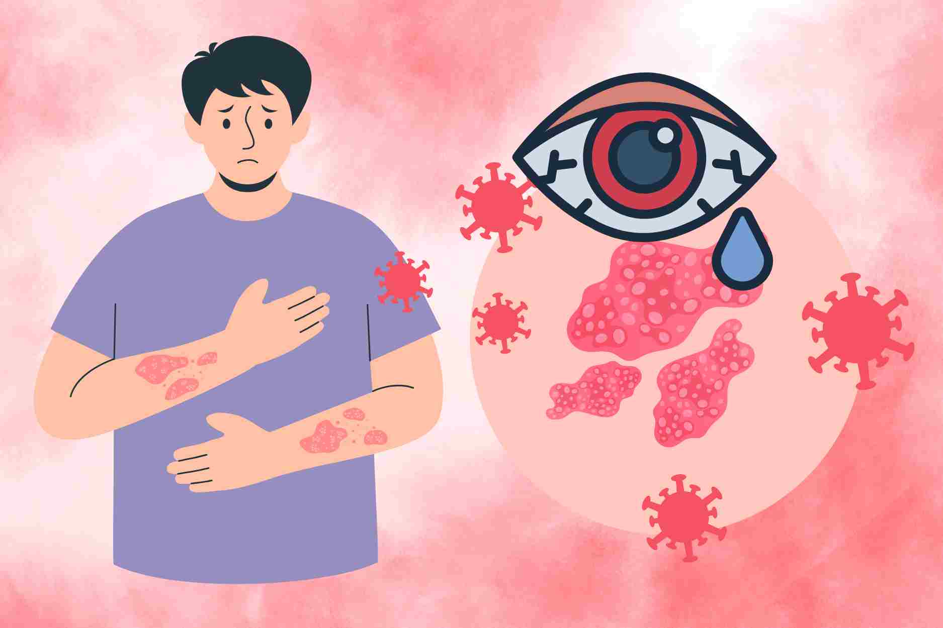 Es una grave complicacion de la zona nerviosa que produce la perdida de la vista