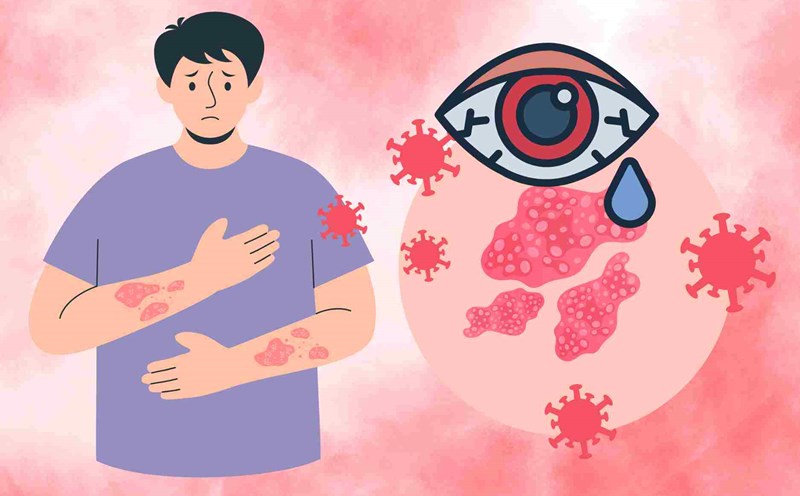 Dangerous complications of shingles that cause vision loss