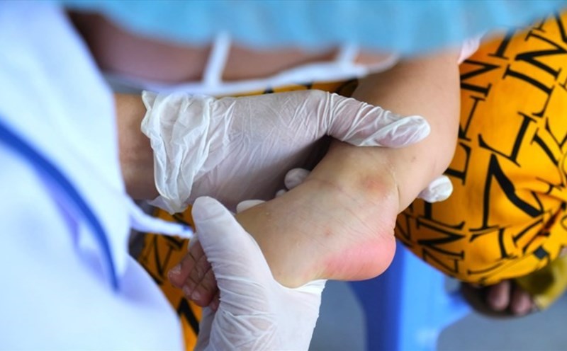 After measles, beware of increased hand, foot and mouth disease in Can Tho