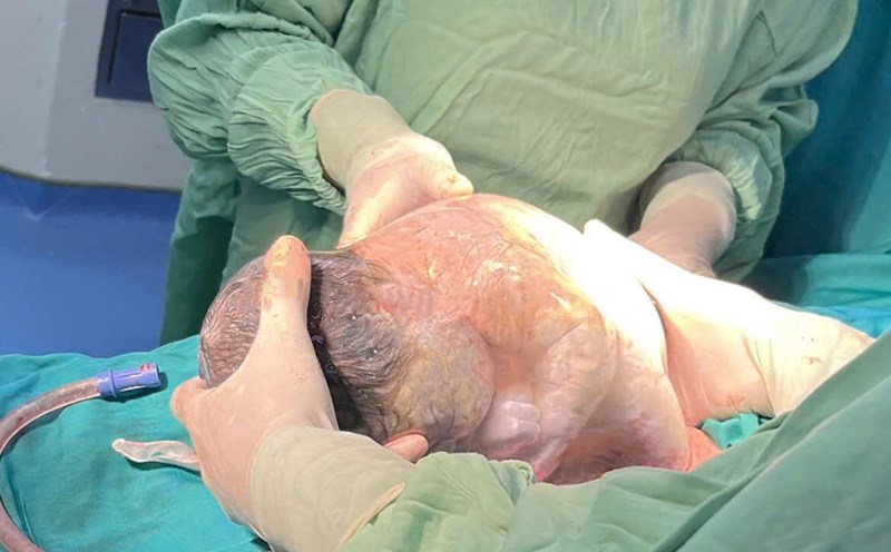 The baby girl was born in a state of being left unharmed at Hoan My Vinh Hospital (Nghe An). Photo: Provided by the hospital