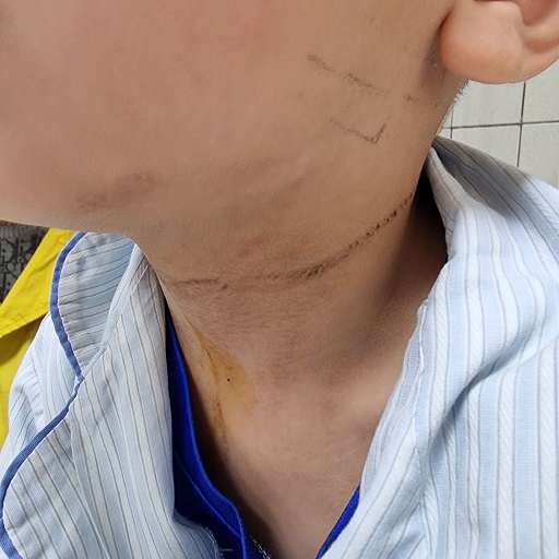 Imagen de la correa en el cuello de un niño de 5 años. Imagen de la pagina web de la Universidad de Wuhan