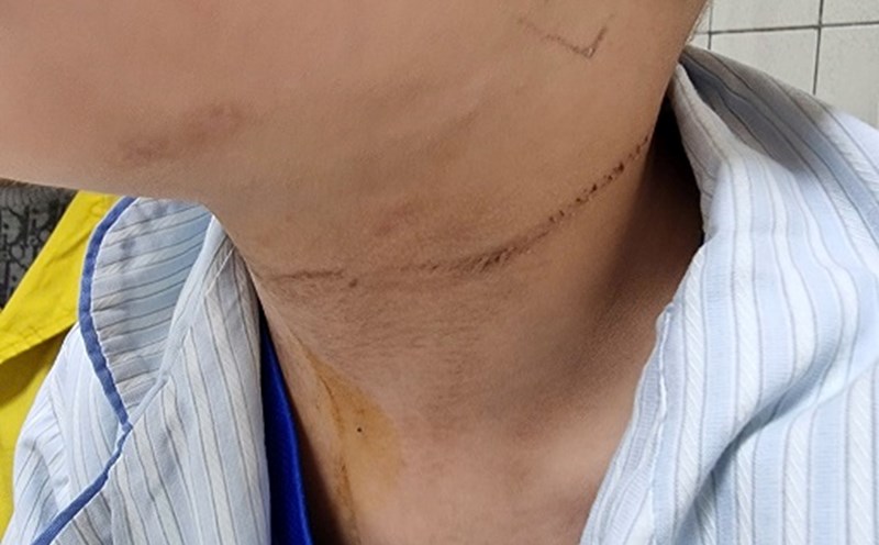Image of a rope around the neck of a 5-year-old boy. Photo: Nguyen Ha