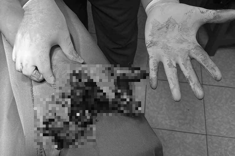 Người đàn ông bị dập nát tay trái do điện thoại phát nổ khi đang sạc. Ảnh: Bệnh viện Đa khoa tỉnh Điện Biên