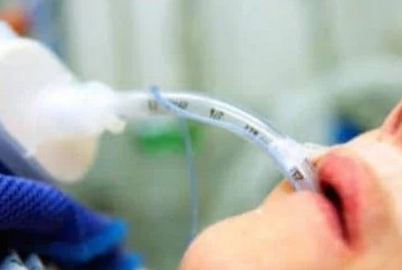 The patient developed severe respiratory failure and had to use an invasive ventilator after being poisoned by Tetradotoxin due to accidentally eating seaweed. Photo: Provided by the hospital