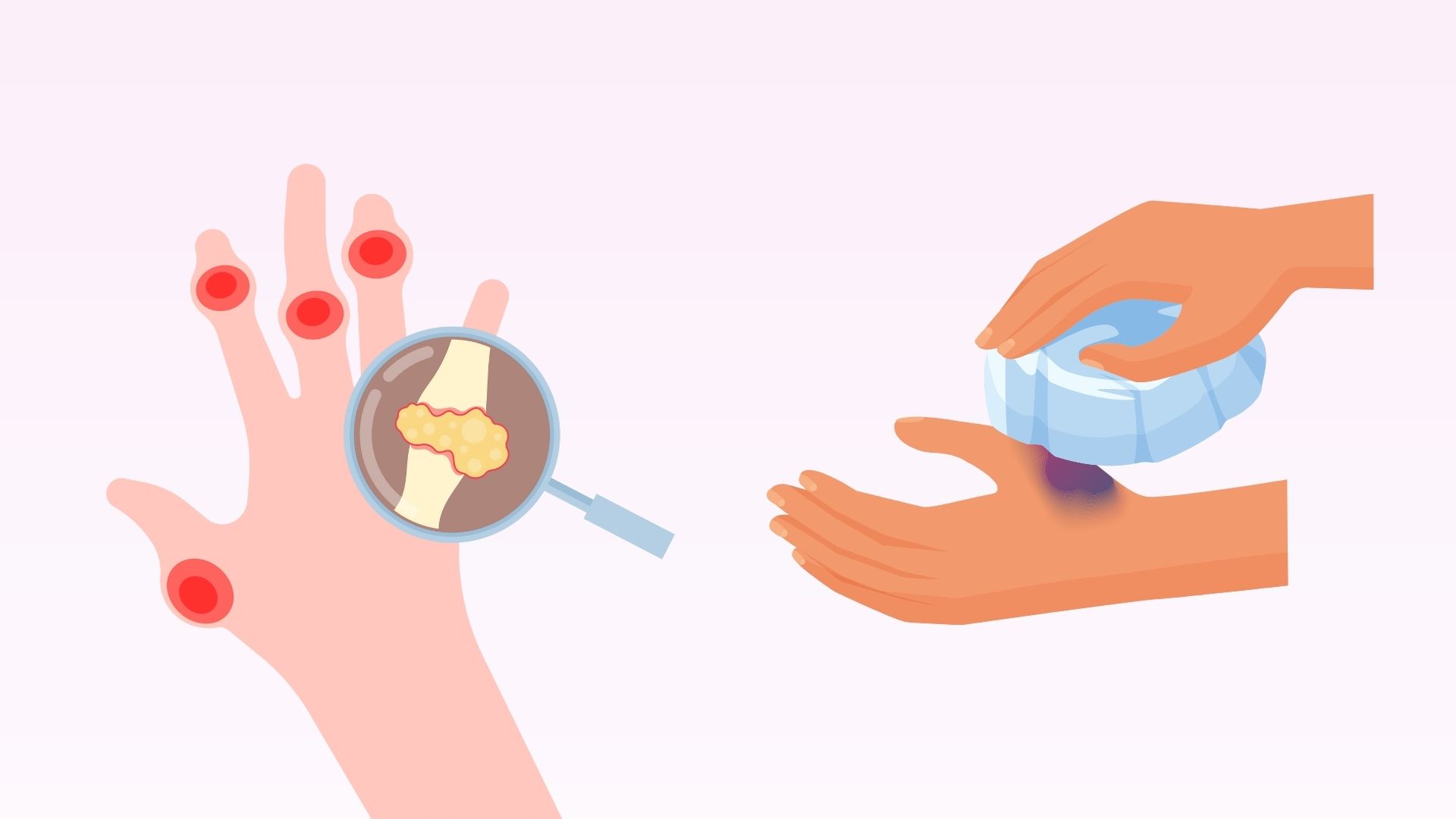 Una de las formas de eliminar el acido urico rapidamente, aliviar el dolor manual causado por la gota son las compresas frias. Grafico: Minh Chau