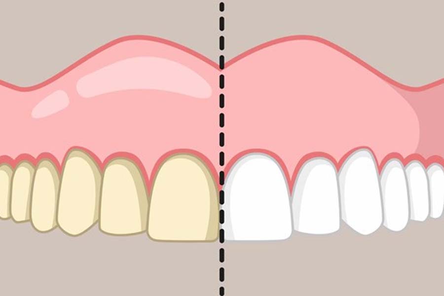 The truth about brushing lemon, coarse salt and mustard oil on teeth to whiten teeth. Graphics: Hoang Loc