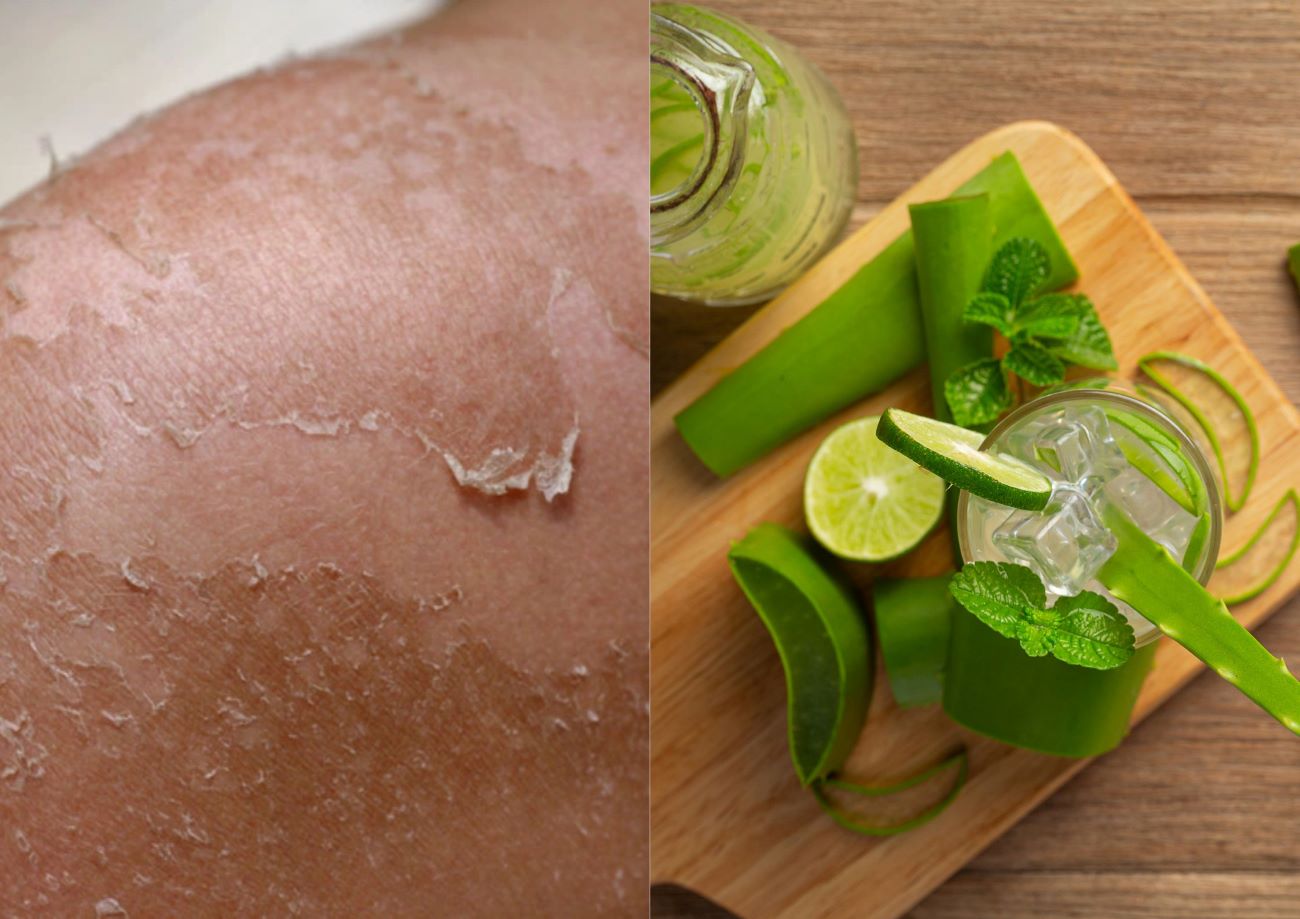 Aloe vera gel can be used to treat peeling skin caused by sunburn. Graphics: Mai Huong