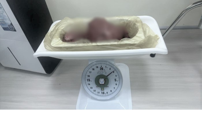 Khoi u xo nang 3kg duoc cat bo. Anh: Song Han