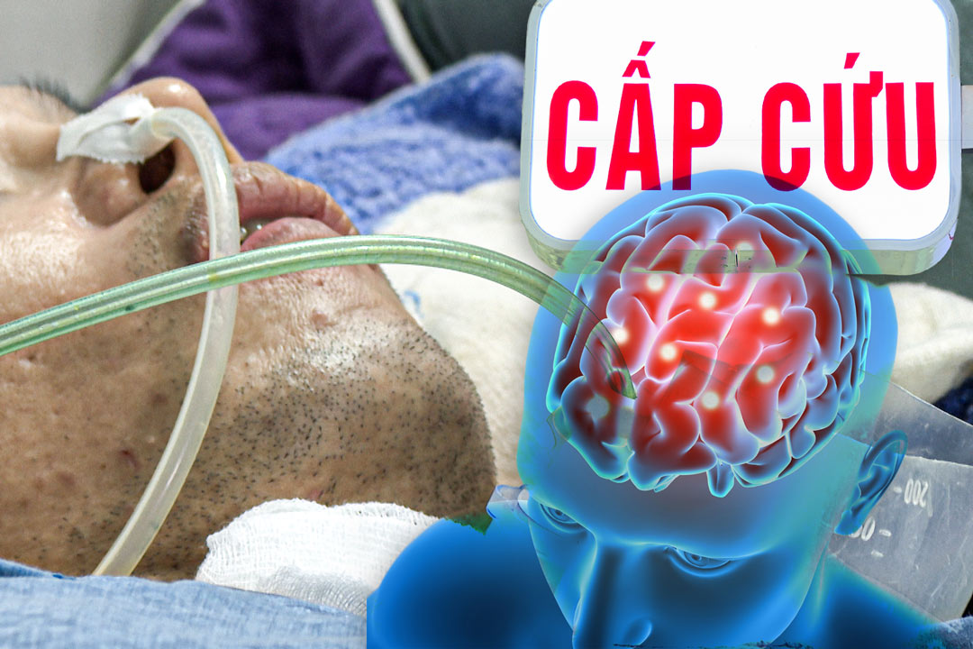 Warning of common causes of stroke in many young people