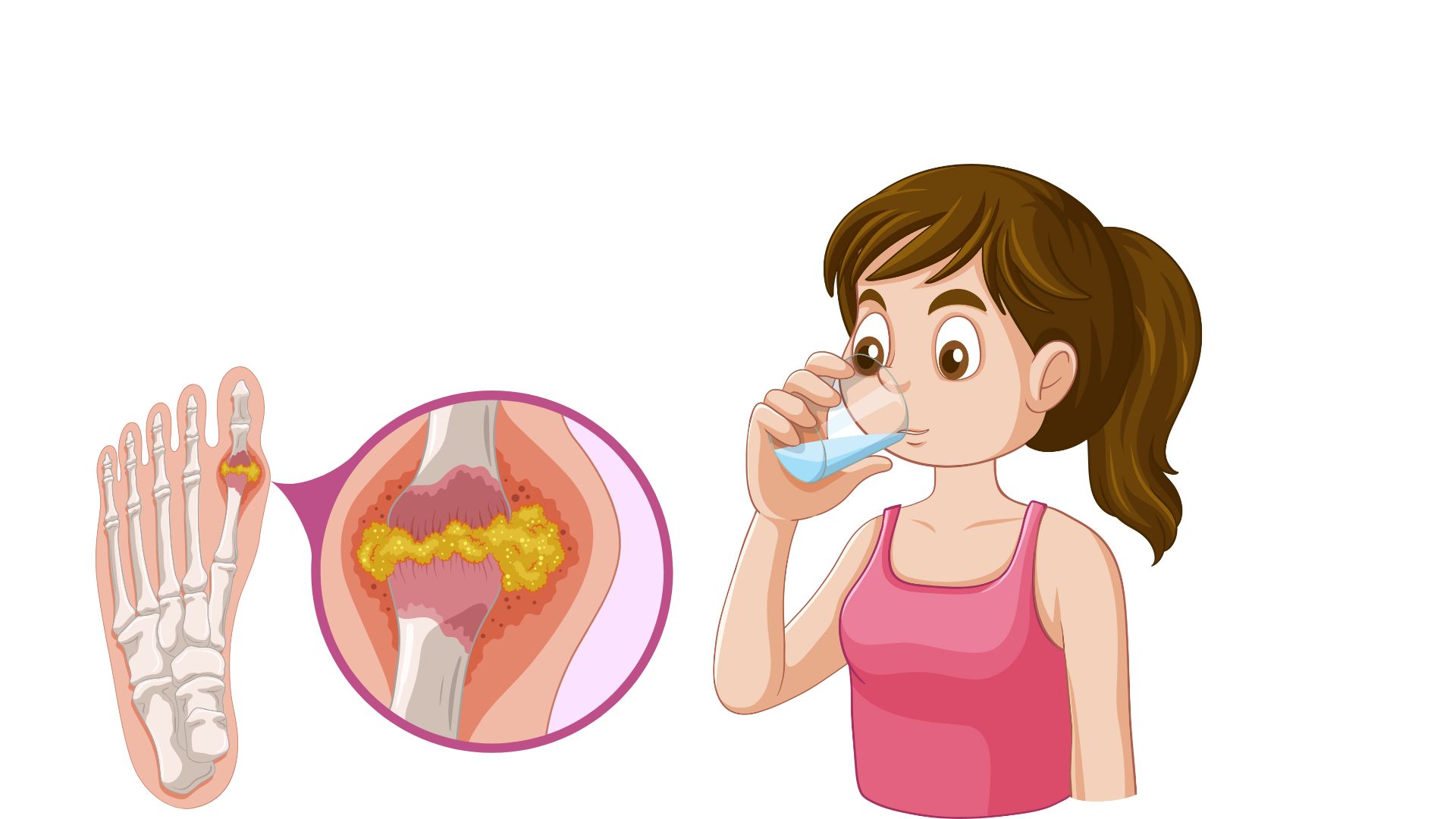 Limiting foods high in purines helps the body not increase uric acid. Graphic photo: HUENG SON