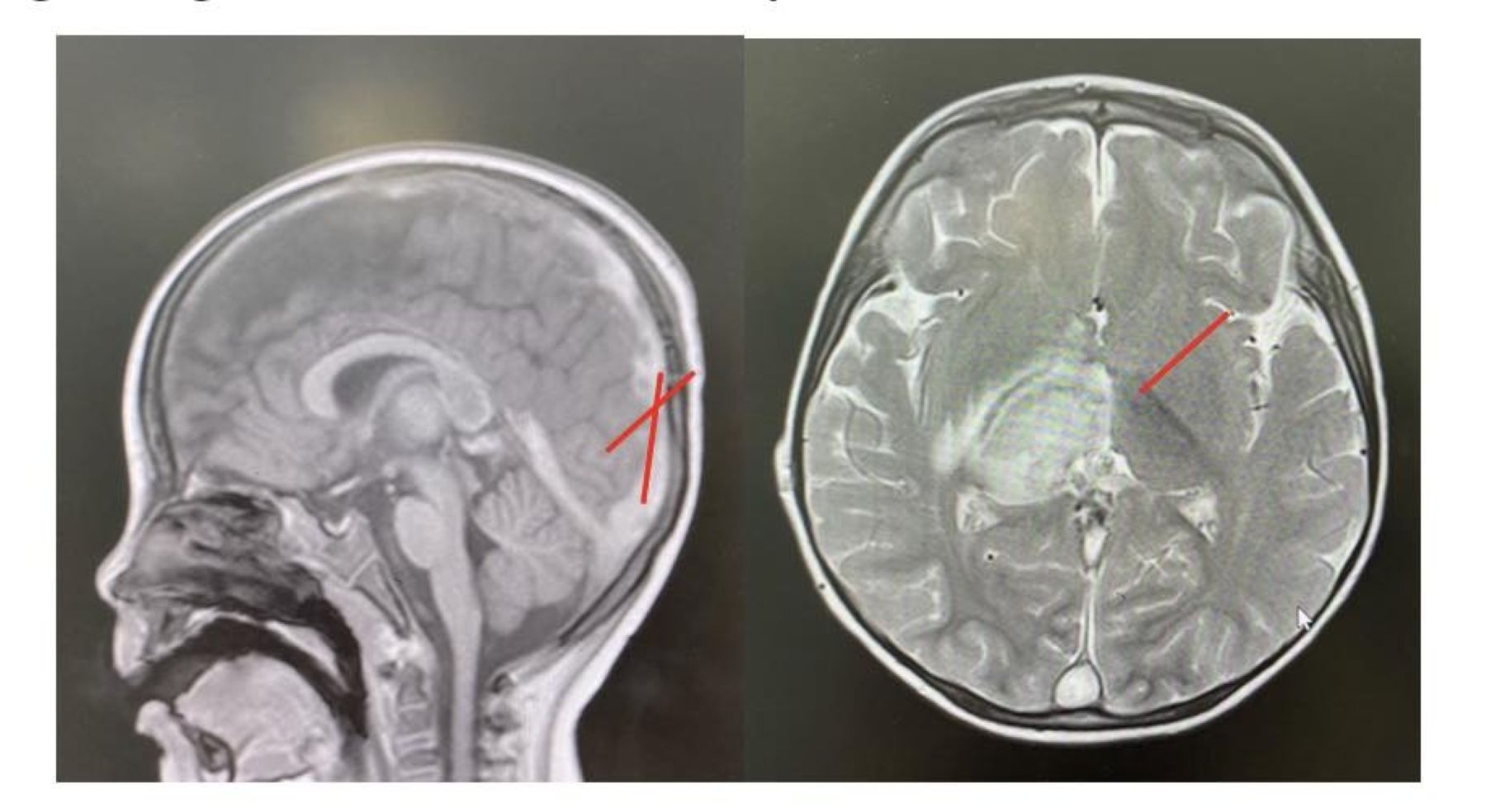 Images of thrombosis and brain damage. Photo: Provided by the hospital