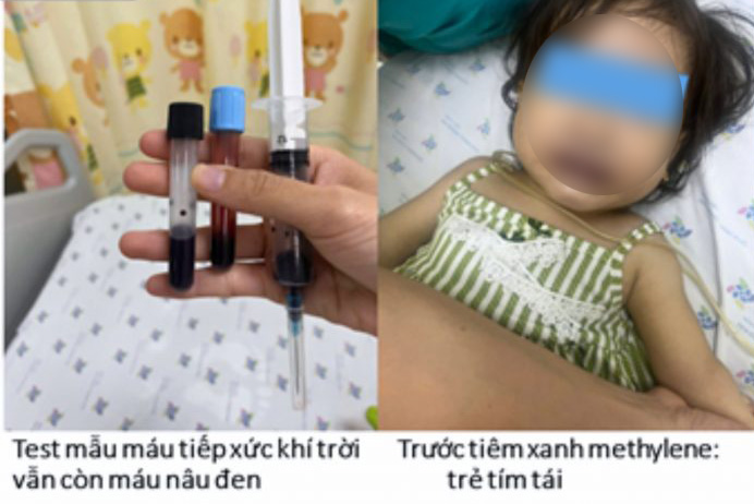 The 16-month-old patient turned purple again due to methemoglobin in the blood. Photo: Provided by the hospital