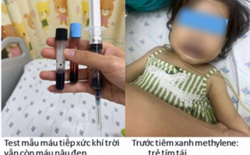 The 16-month-old patient turned purple again due to methemoglobin in the blood. Photo: Provided by the hospital