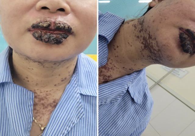 The condition of patients using drugs without permission is treated by a doctor after 5 days, the lesions and blisters gradually dry out. Photo: Provided by the hospital