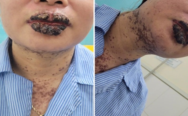 The condition of patients using drugs without permission is treated by a doctor after 5 days, the lesions and blisters gradually dry out. Photo: Provided by the hospital