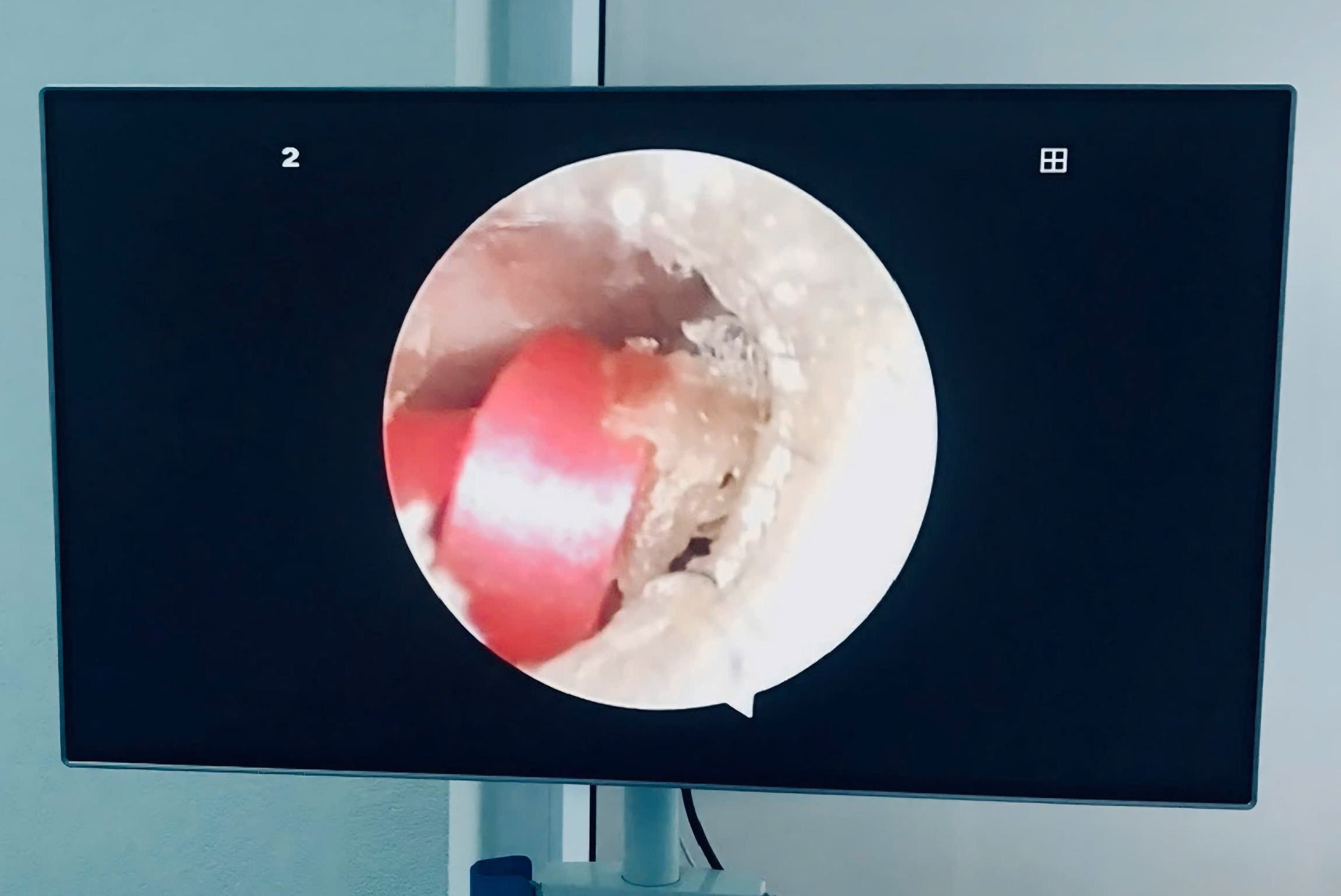 A 6-year-old girl almost puncture her Ngoi to a hair rope. Photo: Thanh Dang