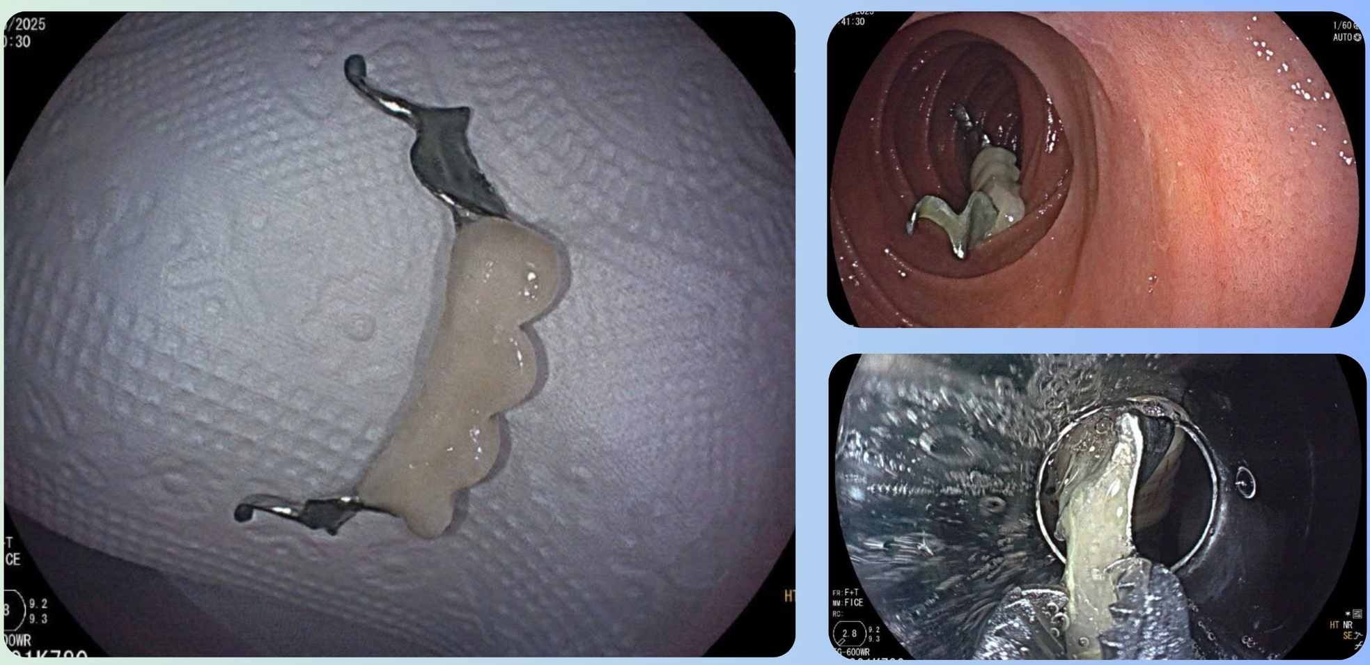 Endoscopists remove foreign objects from the patient's body. Photo: BVCC