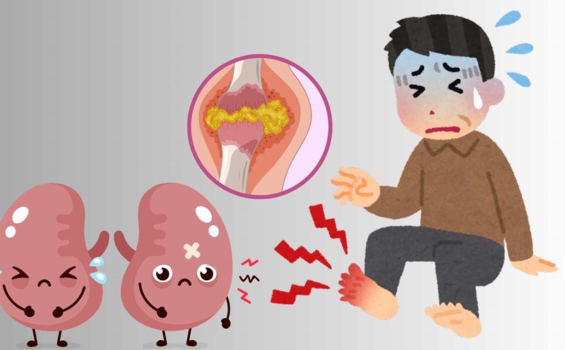 There is a link between gout and kidneys. Graphics: Ha May