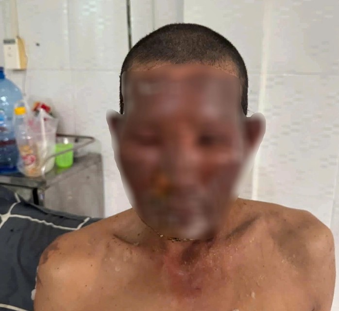 Một nạn nhân đang điều trị tại Trung tâm Y tế huyện Thới Bình, tỉnh Cà Mau bị phỏng do nổ bình gas mini. Ảnh: Nhật Hồ