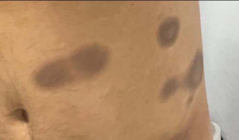 Dark redness appeared on the patient's body due to drug allergy. Photo: BVCC