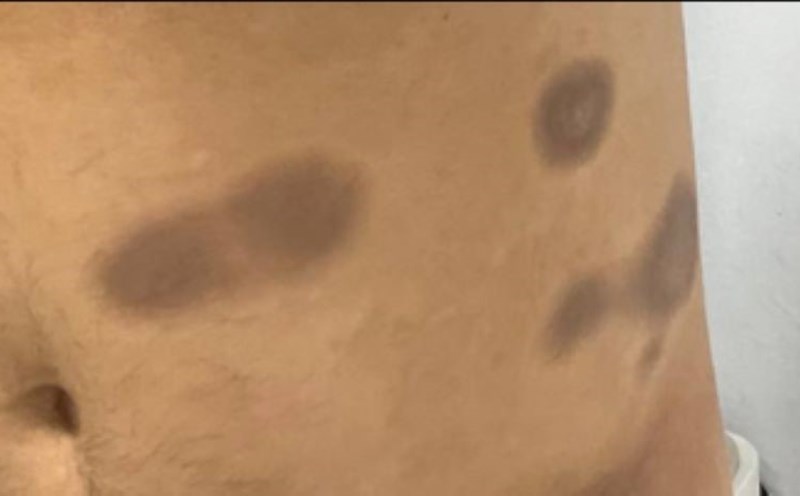 Dark redness appeared on the patient's body due to drug allergy. Photo: BVCC