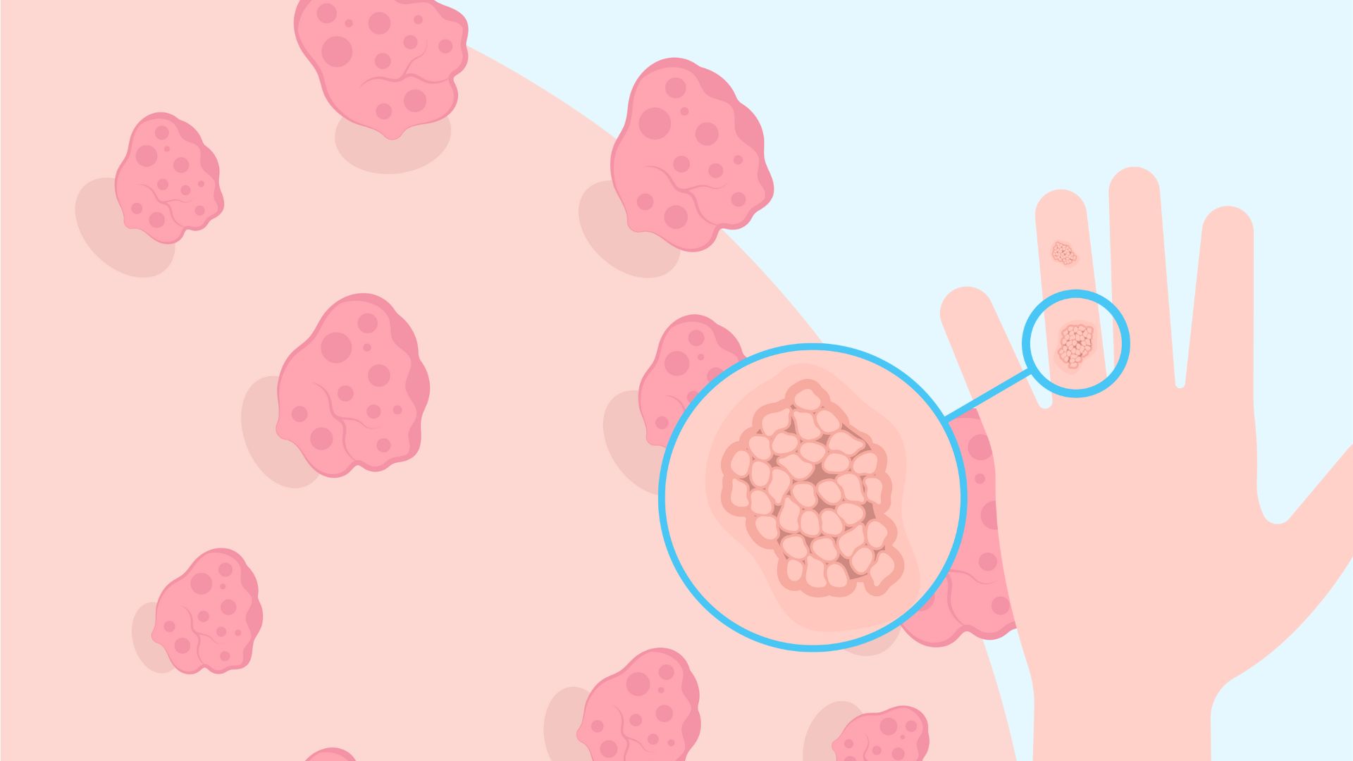Chickenpox is a common disease transmitted through sexual intercourse. Graphic photo: Nguyen Ly