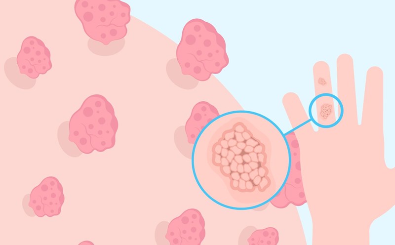 Chickenpox is a common disease transmitted through sexual intercourse. Graphic photo: Nguyen Ly