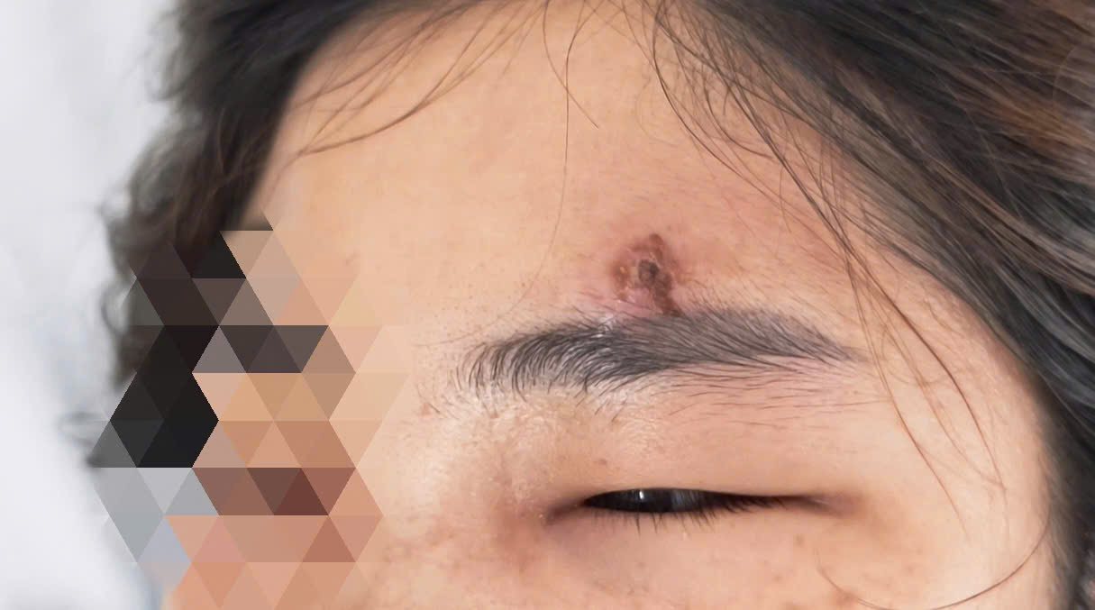 After shaping acne with her hands, the female patient was hospitalized for critical placenta inflammation. Photo: Thanh Dang