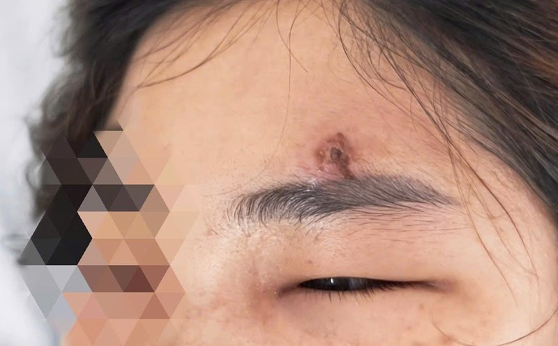 After shaping acne with her hands, the female patient was hospitalized for critical placenta inflammation. Photo: Thanh Dang