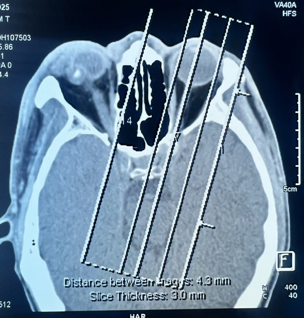 The foreign object in the eye is pressured, causing the eyeball to deform moderately. Photo: Provided by the hospital
